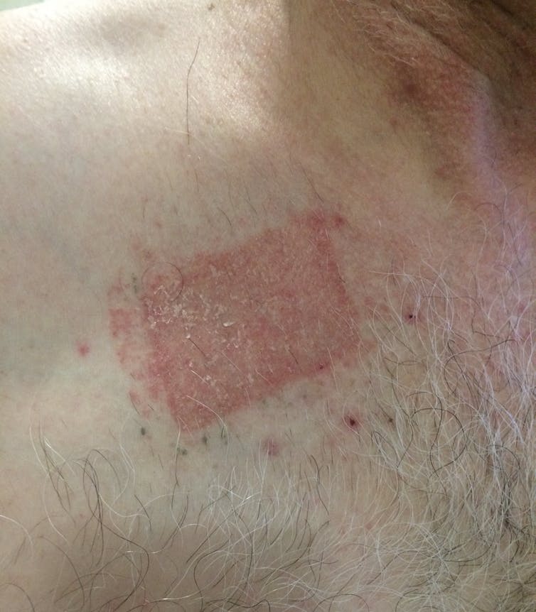 Skin rubbing rash spots pictures